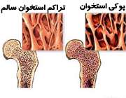 سنجش تراکم استخوان