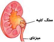 سنگ کلیه