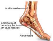 plantar fasciitis