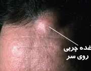 Image result for ‫تومور روی صورت یا گردن‬‎