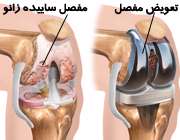 جراحی تعویض مفصل