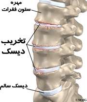 تخریب دیسک مهره‌ ستون فقرات