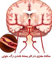 سکته مغزی