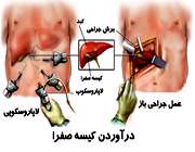 درآوردن کیسه صفرا با عمل جراحی 