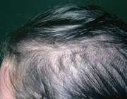درمان ریزش مو ناشی از کم کاری تیروئید