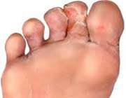 athlete foot