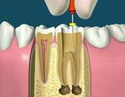 ایا عصب کشی درد دارد کدام دندانپزشک برای عصب کشی مناسب است
