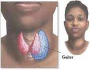 natural remedies for curing goiter