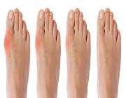 what is gout?