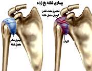 بیماری و مشکلات شانه