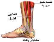 تاندون آشیل