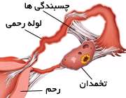 چسبندگی لوله رحمی