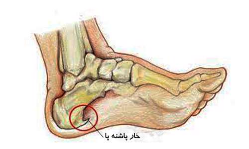 خار پاشنه پا