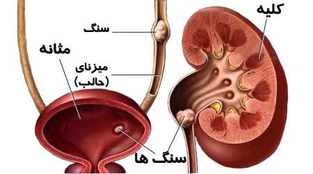 سنگ ادراری