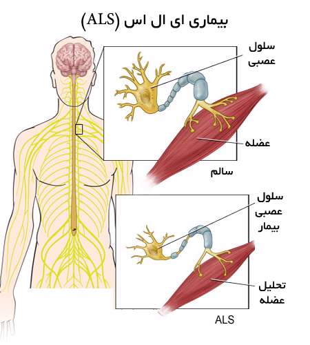 بیماری ای ال اس