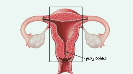 برداشتن رحم