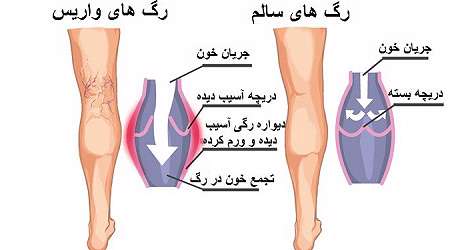 واریس پا