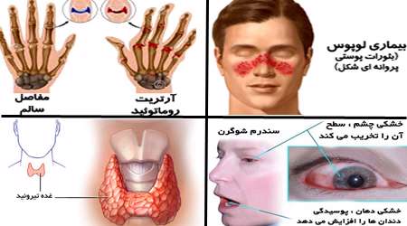 بیماری های خودایمنی