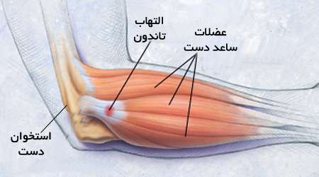 التهاب تاندون