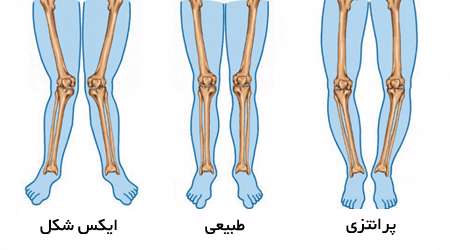پاهای پرانتزی و ایکس شکل