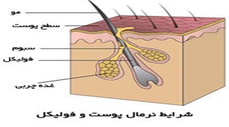 ساخت صابون ضد آکنه گیاهی