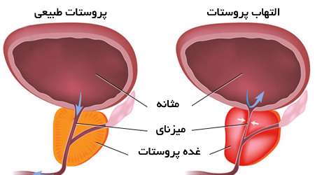 پروستاتیت