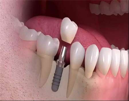 الأسنان، جراحة زراعة الأسنان، صحه، الطب
