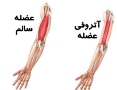 آتروفی عضلات، آتروفی ماهیچه،    تحلیل عضله،