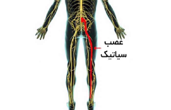 عصب سیاتیک، سیاتیک، درد سیاتیک،