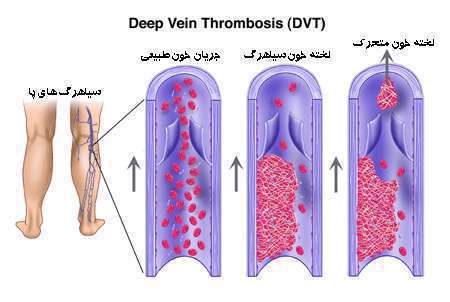  ترومبوز ورید عمقی،  لخته شدن خون، لخته خون متحرک، لخته خون سیاهرگ، جریان خون طبیعی،