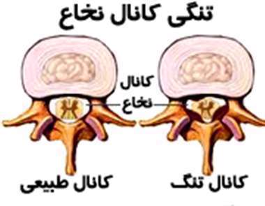 تنگی کانال نخاع، کانال نخاع، تنگ شدن مجرای نخاع،