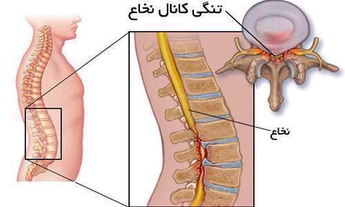 تنگی کانال نخاع، کانال نخاع، تنگ شدن مجرای نخاع،