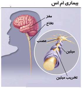 بیماری ام‌اس، اعصاب، سیستم عصبی مرکزی، مغز، نخاع، تخریب میلین اعصاب،