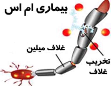 بیماری ام اس،