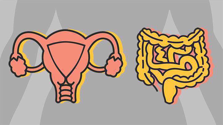 سندروم روده تحریک پذیر و سرطان تخمدان