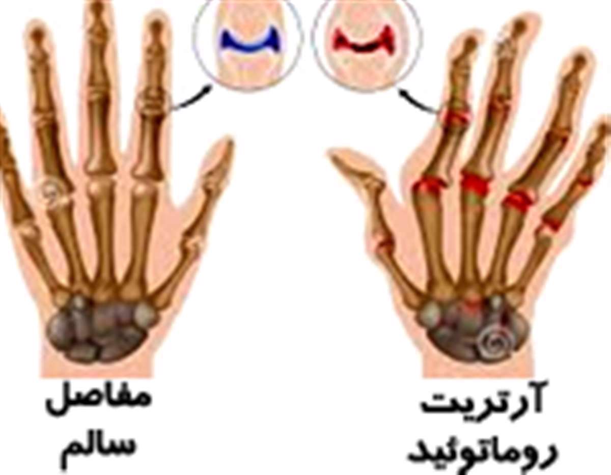 ساییدگی و پارگی غضروف مفاصل ، آرتریت،