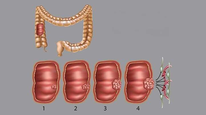 مراحل 4 گانه سرطان کولون