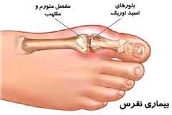 بیماری نقرس ، درد مفصل ، ورم مفصل شست پا