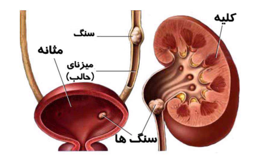 کلیه، سنگ کلیه، بیماری کلیه،