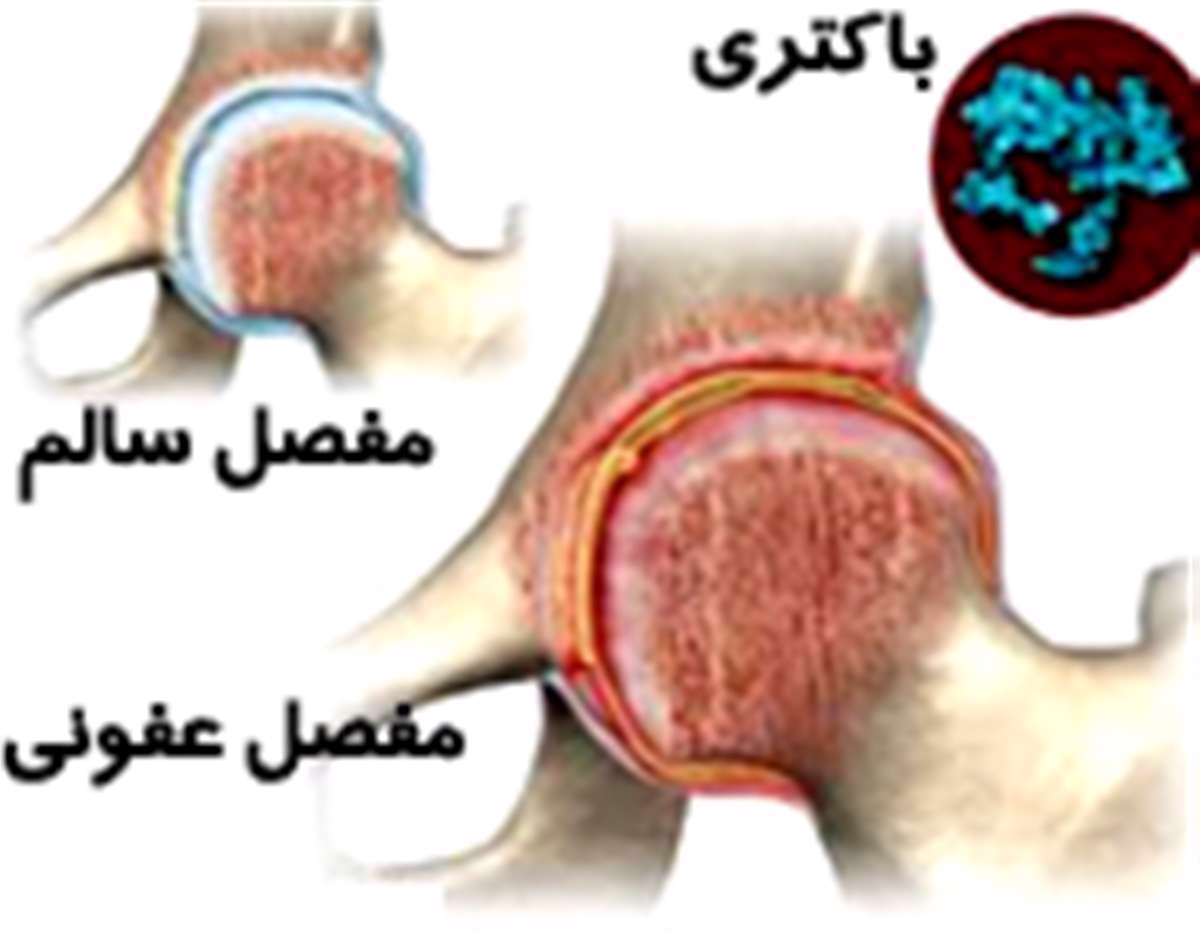 septic arthritis - آرتریت عفونی - درد مفاصل عفونی - 