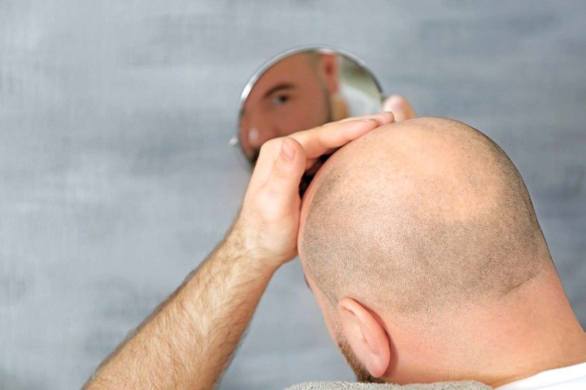 معرفی جدیدترین روش‌های کاشت مو در جهان