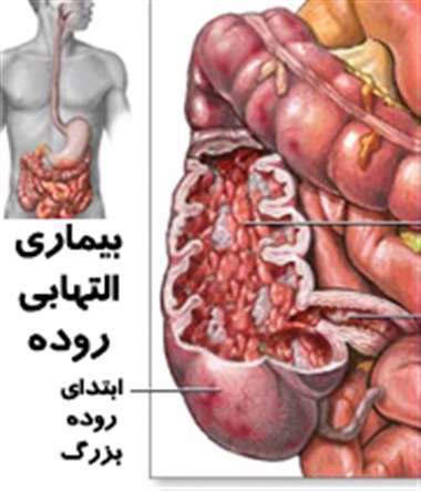 کولیت اولسراتیو  - کولیت زخمی - بیماری‌ التهابی روده