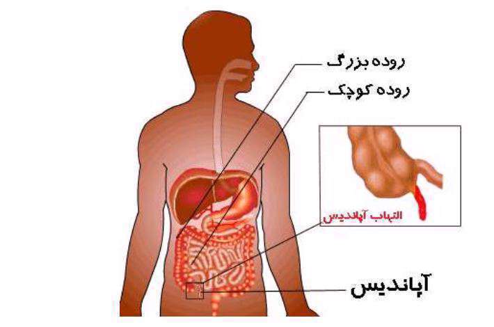 آپاندیسیت -آپاندیس