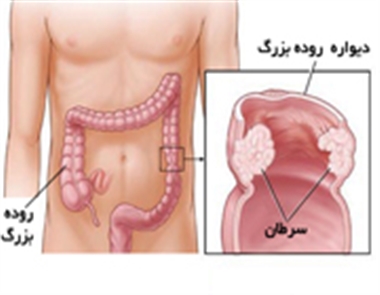 سرطان روده بزرگ ،سرطان، روده بزرگ،