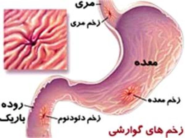 زخم معده، زخم گوارشی