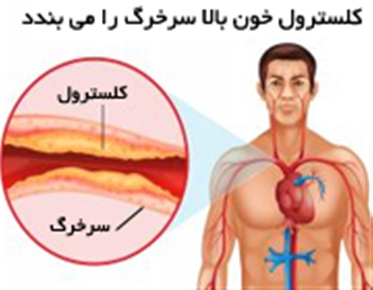 کلسترول خون بالا، انسداد رگ، سرخرگ،