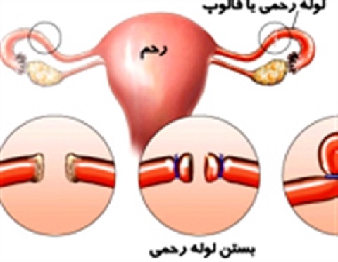 بستن لوله های رحمی، سرطان تخمدان ،