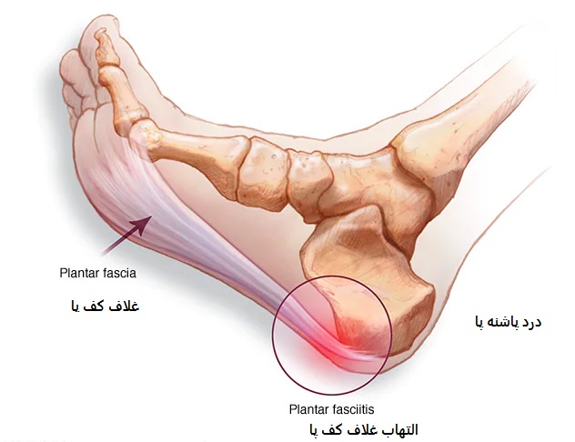 درد پاشنه پا  ، التهاب غلاف کف پا ،  فاسئیت پلانتار   ، فاسیای پلانتار ،  فاشیای پلانتار،
