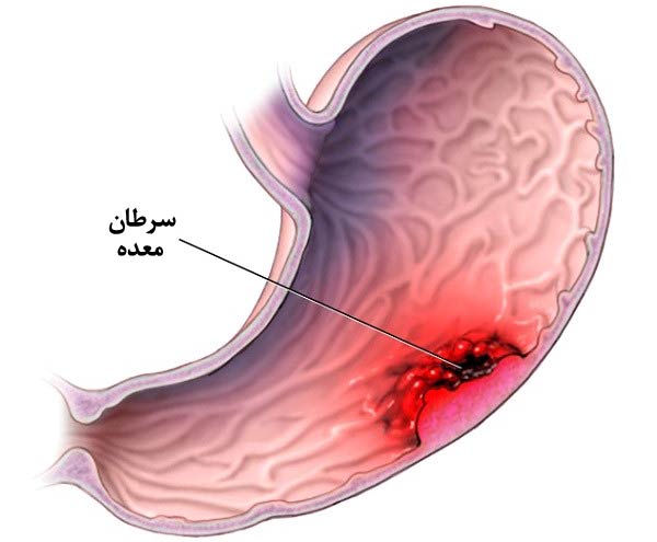 سیگار و سرطان معده