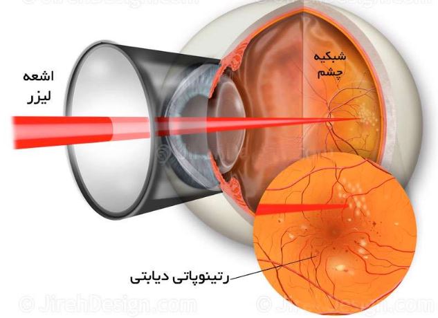 رتینوپاتی دیابتی ،  چشم دیابتی ، مشکل چشمی دیابت ،